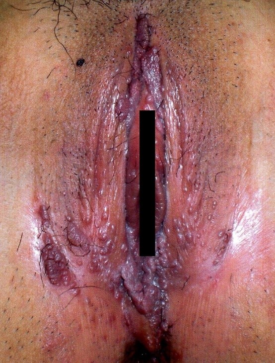 コンジローマ症例写真